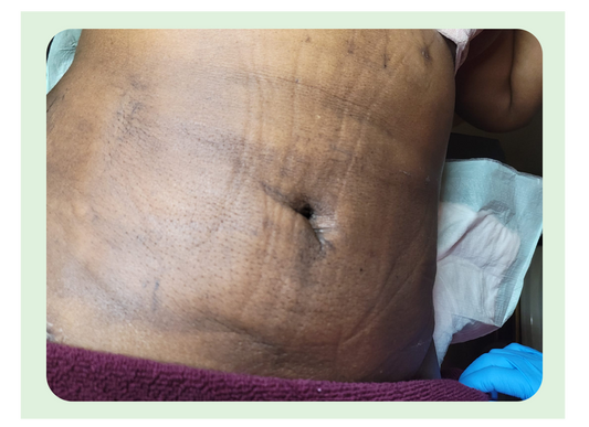 AFTER SURGERY FIBROSIS😱