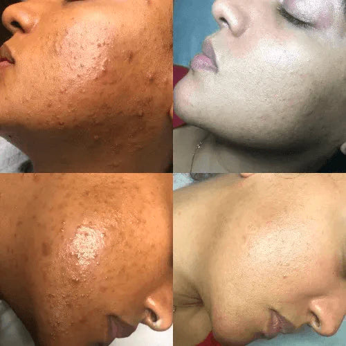 Acne Treatments