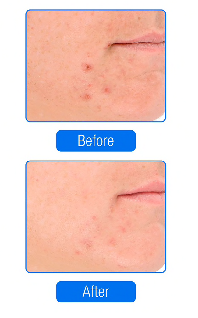 Lightstim for Acne